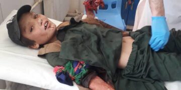 انفجار سرگلوله هاوان در غور انگشتان کودک ۱۱ ساله را قطع کرد